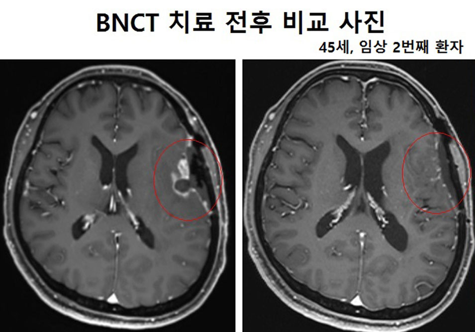 45세, 임상 2번째 환자 BNCT 치료 전후 비교 사진