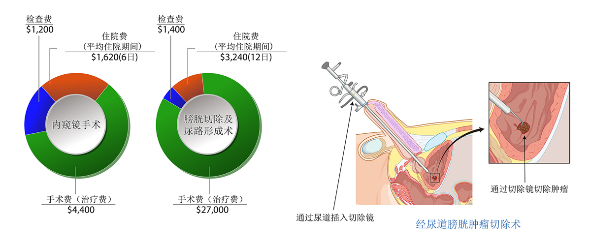 膀胱癌