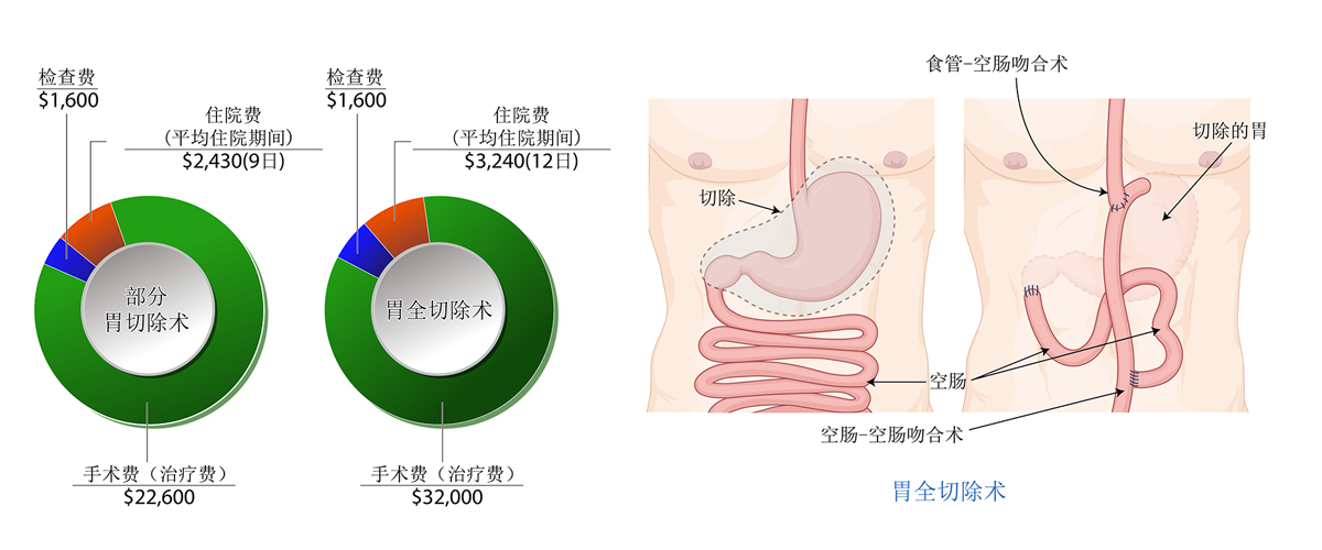 胃癌