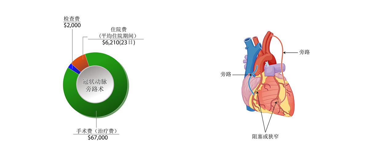 冠状动脉旁路术