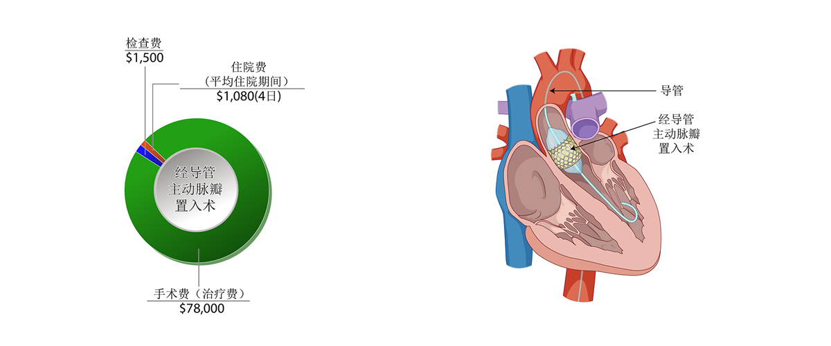 经导管主动脉瓣置入术