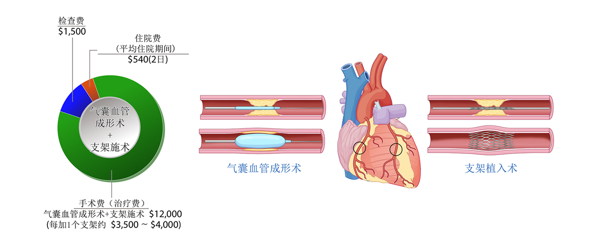 经皮冠状动脉介入术