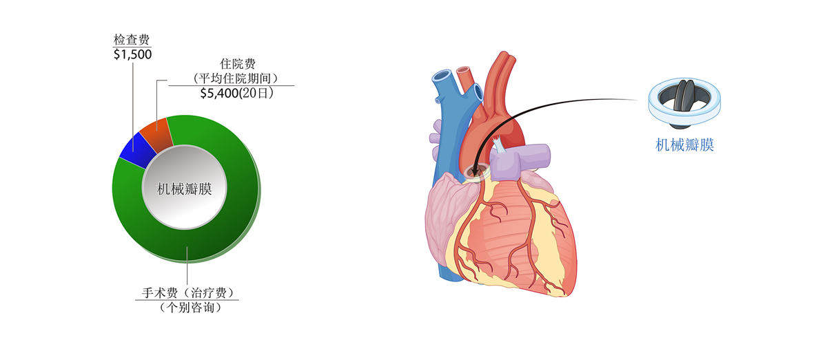 心脏瓣膜置换术