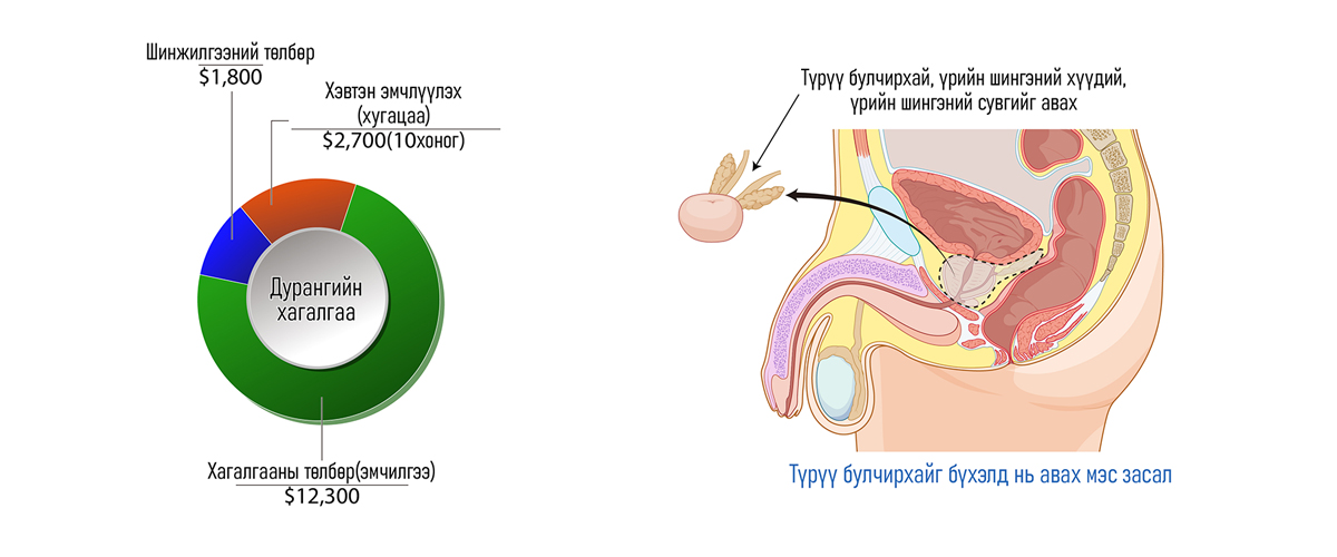 Түрүү булчирхайн хавдар