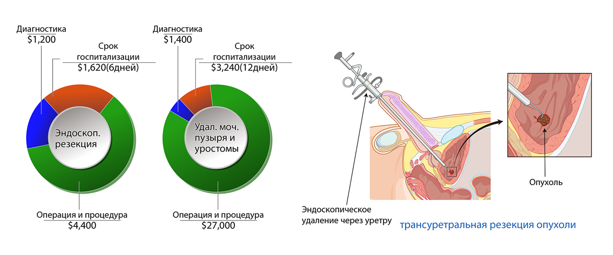 Рак мочевого пузыря