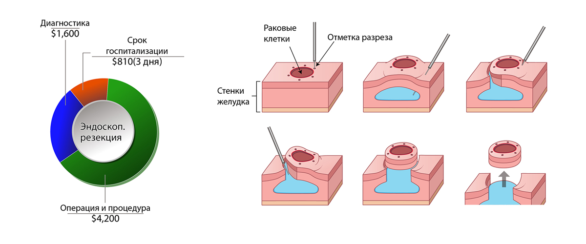 Рак Желудка