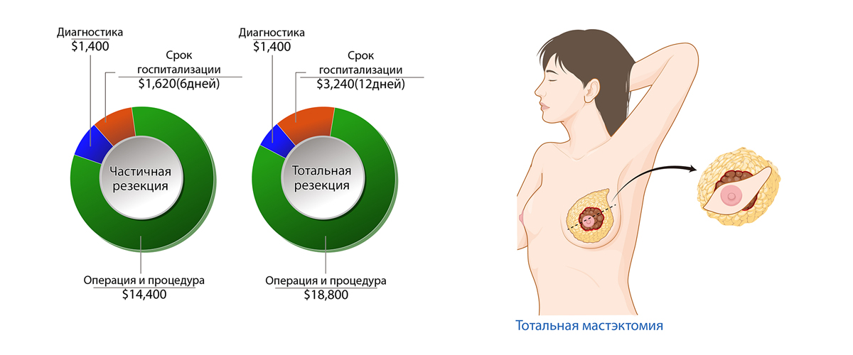 Рак молочной железы