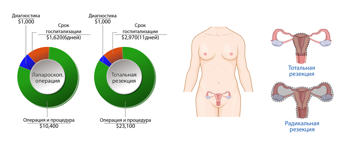 Рак матки