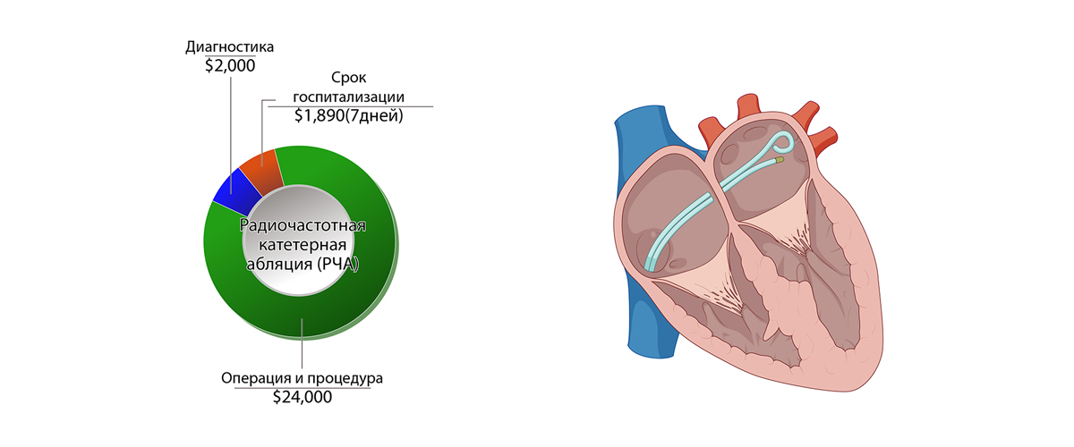 Радиочастотная катетерная абляция (РЧА)