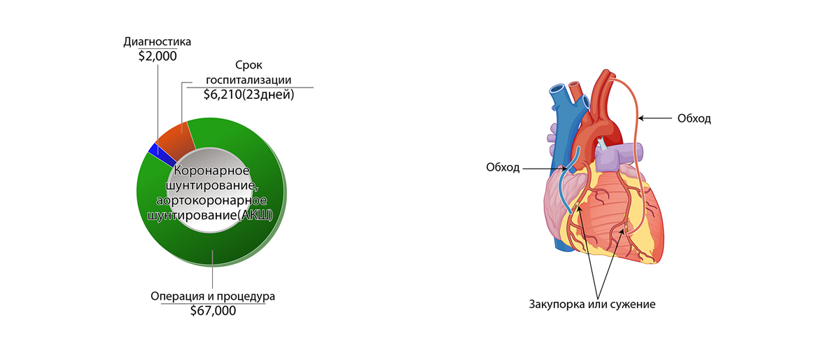 Коронарное шунтирование, аортокоронарное шунтирование (АКШ)