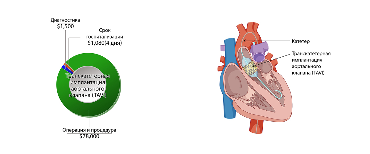 Транскатетерная имплантация аортального клапана (TAVI)