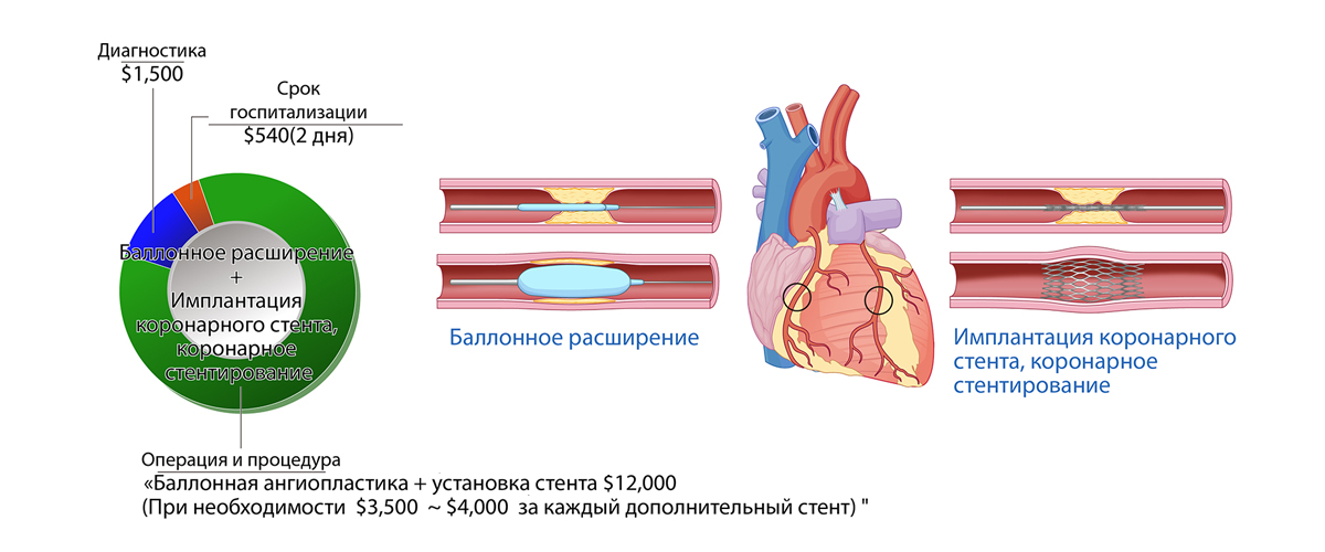 Чрескожное коронарное вмешательство (ЧКВ)/Коронарная ангиопластика