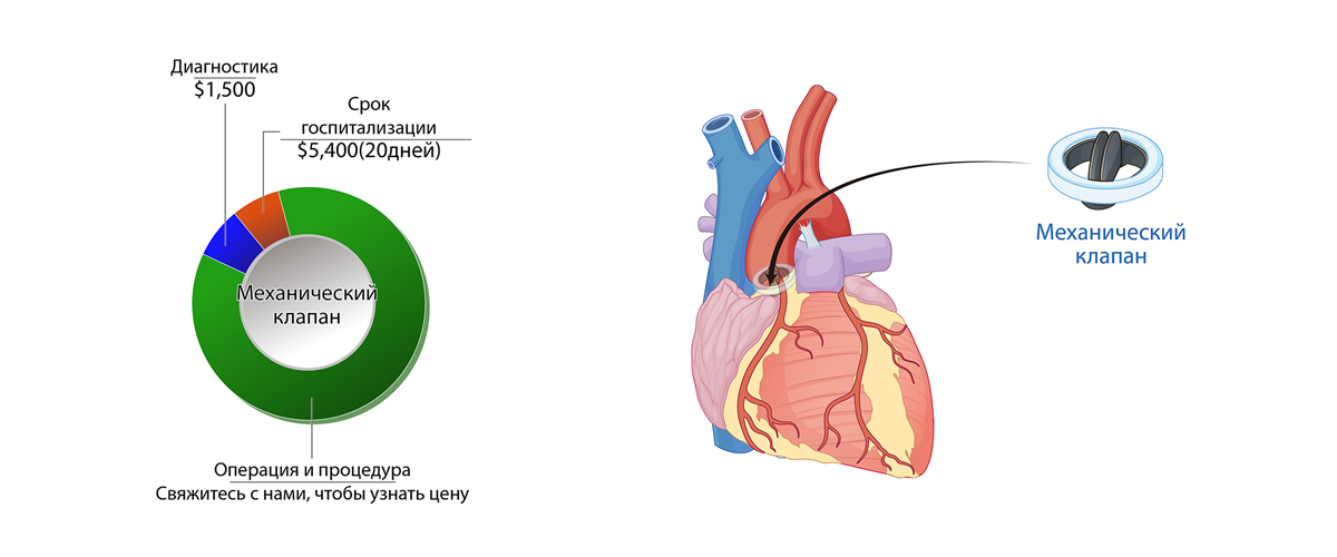 Операция по замене сердечного клапана