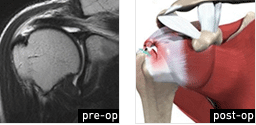 Rotator Cuff Repair