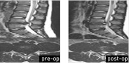 Spine Discectomy Surgery