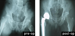 Total Joint Replacement