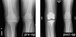 Total Knee Replacement